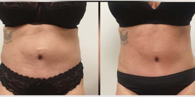 Braziliaanse lymfedrainage voor na