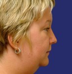 Chirurgie van de dubbele kin lipo-sculptuur + nekcorrectie