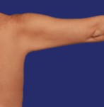 Foto van patiënt na liposuctie van de armen, met meer getonifieerde armen