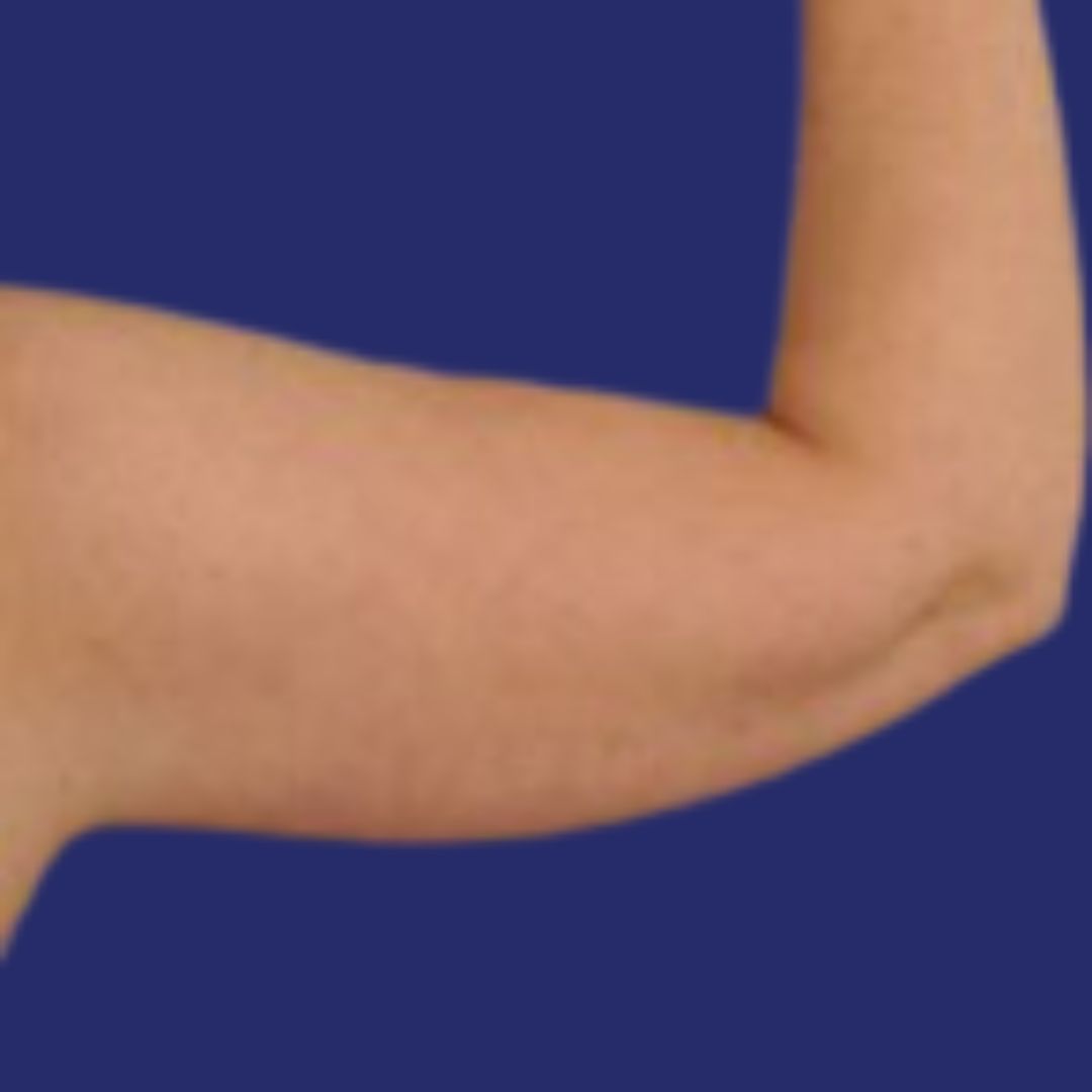 transformatie voor en na de liposuctie van de armen