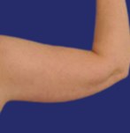 transformatie voor en na de liposuctie van de armen