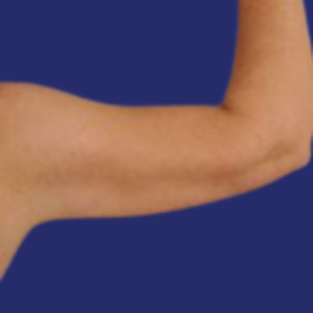 Resultaten van liposuctie van de armen