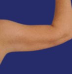 Resultaten van liposuctie van de armen