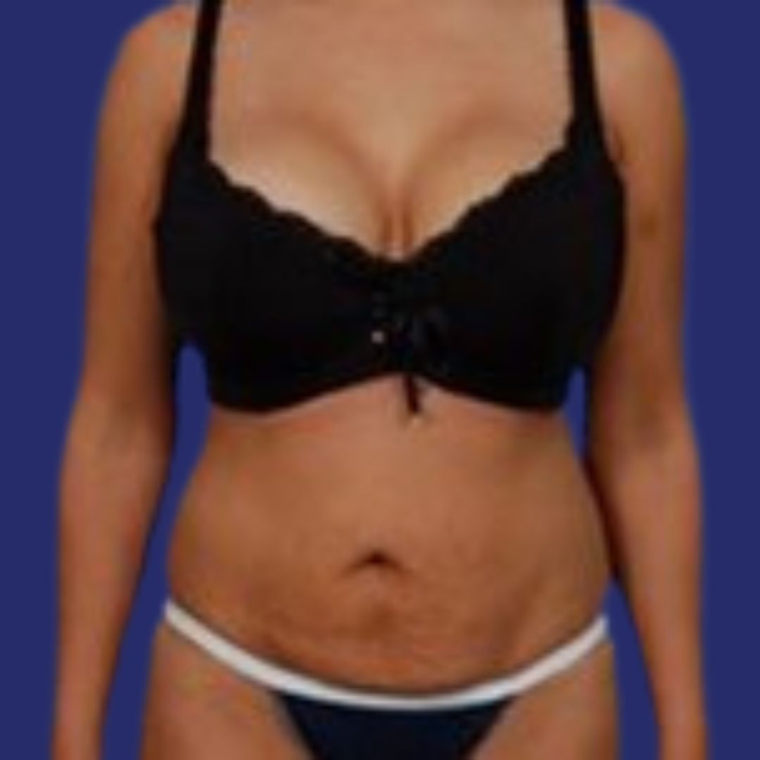 Voor Abdominoplastie om de buik te verstevigen en te definiëren  