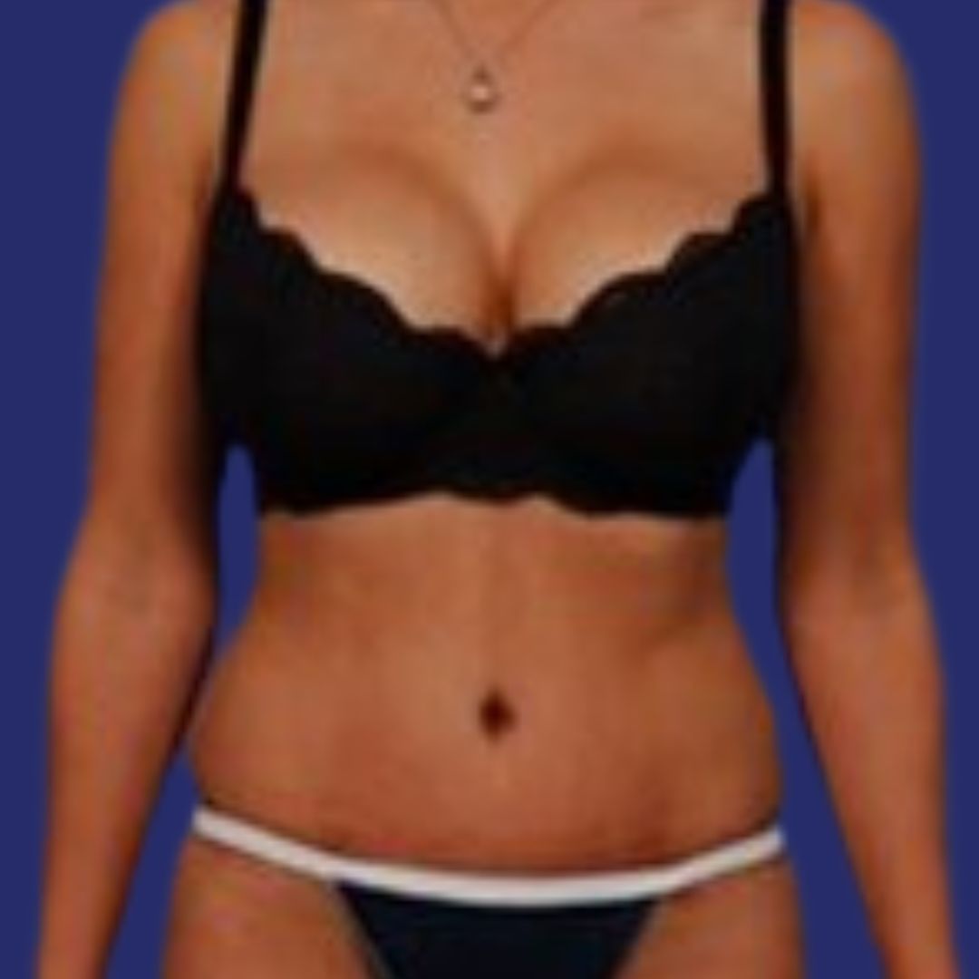 Na buikwandcorrectie voor een stevigere en esthetischere buik