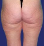liposuctie billen