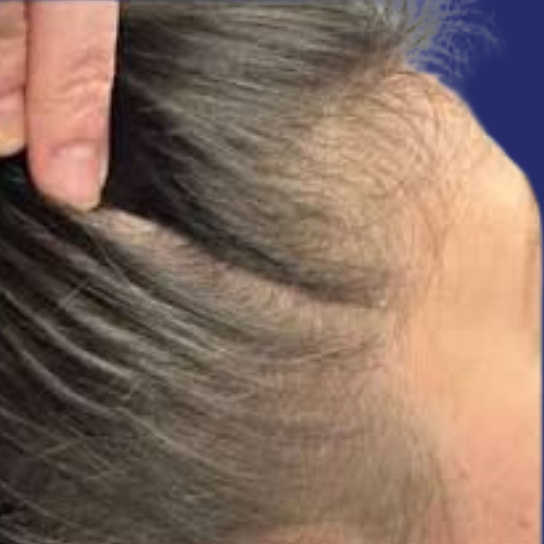 Voor foto haaruitval: dunner wordend haar en terugtrekkende haarlijn vóór PRP behandeling tegen haarverlies