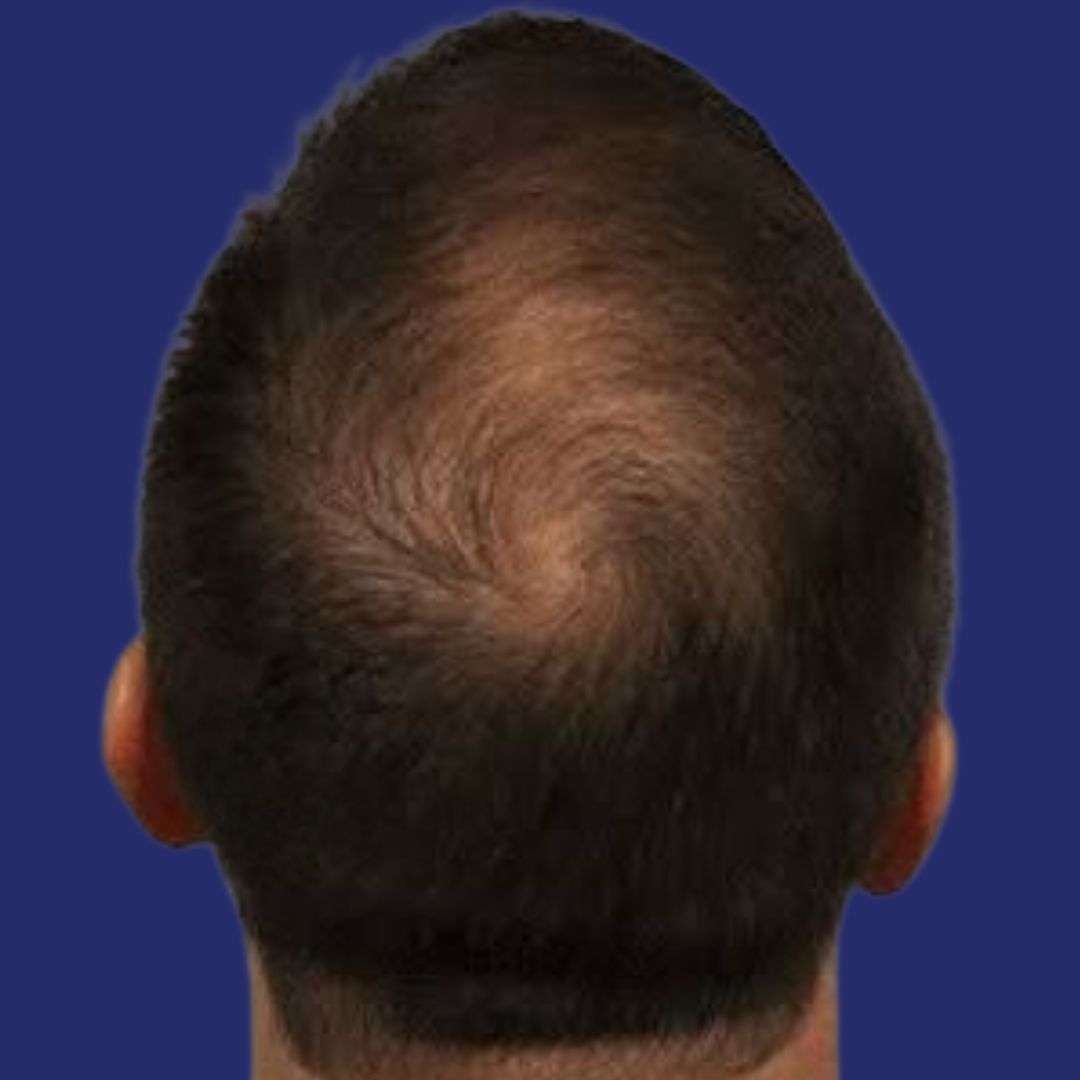 Na PRP therapie: gezondere hoofdhuid en sterkere haarfollikels met nieuwe haargroei