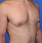 Voor gynaecomastie chirurgie