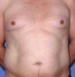 Vergelijking van mannelijk abdomen voor en na liposuctie