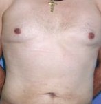 abdomen voor en na liposuctie