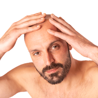 Voor-en-na-foto's van een haartransplantatie: Haartransplantatie