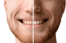 Tanden witmaken: dental bleaching