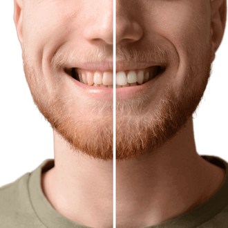 Voor-en-na-foto's tanden bleken: Tanden witmaken