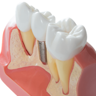Voor-en-na-foto's tandimplantaten: Tandimplantaten
