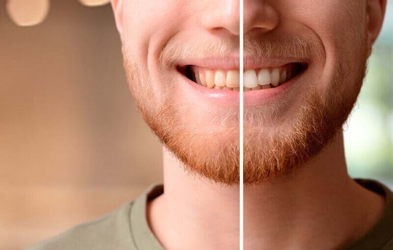 Tanden witmaken: dental bleaching