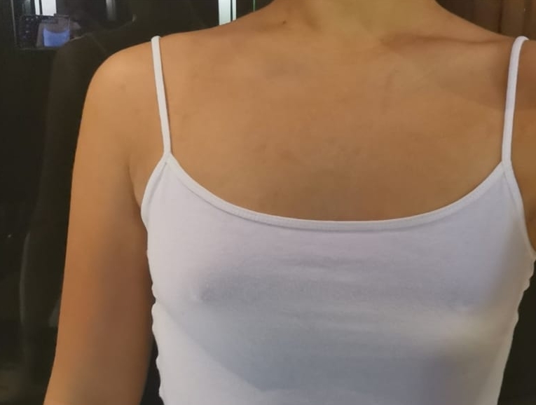 Voor Borstvergrotingsoperatie met 340cc XP-implantaten