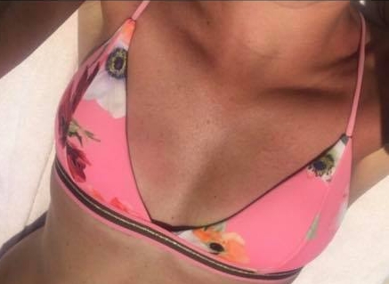 Voor Borstvergroting met implantaten van 380cc XP bij de Wellness Kliniek 