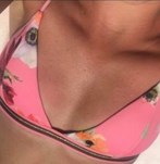 Voor Borstvergroting met implantaten van 380cc XP bij de Wellness Kliniek