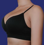 Na Borstvergrotingsoperatie met implantaten van 240cc XXP