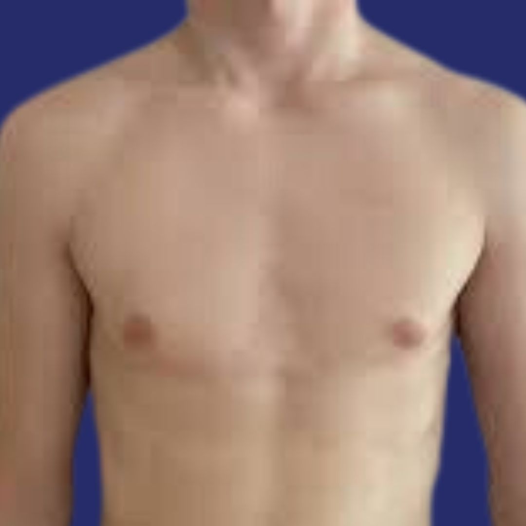 Voor transgender borstvergroting