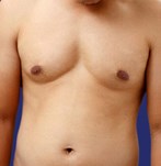 Voor - Mannelijke borstverkleining en buikmarkering