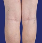 Afbeelding van prominente aders op de benen voor vasculaire behandeling