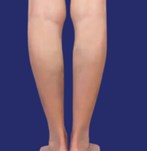 Resultaat van gladdere benen zonder zichtbare aders na vasculaire behandeling