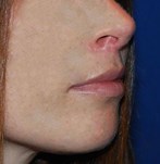 Profielweergave van het gezicht na een lip lift, met een meer gedefinieerde contour van de bovenlip.