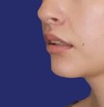 Lachende close-up van lippen na een lip lift, met verhoogde blootstelling van de bovenlip.