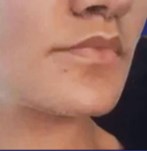 Close-up van lippen na een lip lift ingreep, met verbeterde definitie.