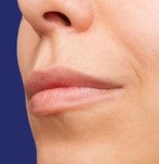 Profielfoto van het gezicht vóór de lip-filler