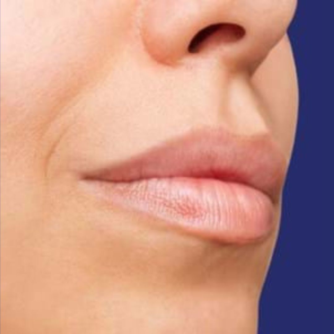 Profielfoto van het gezicht vóór de lip-filler