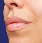 Profielweergave van het gezicht na een lip filler, met verjongde lipcontouren