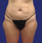 Liposuctie zadeltassen - voor