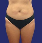 Foto resultaten liposuctie zadeltassen