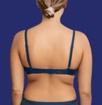 Voor liposuctie op de rug van een vrouw