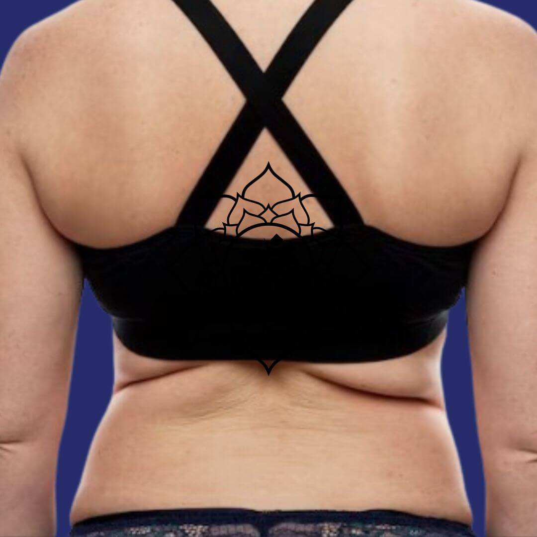 Foto voor liposuctie op de rug 