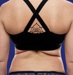 Foto voor liposuctie op de rug