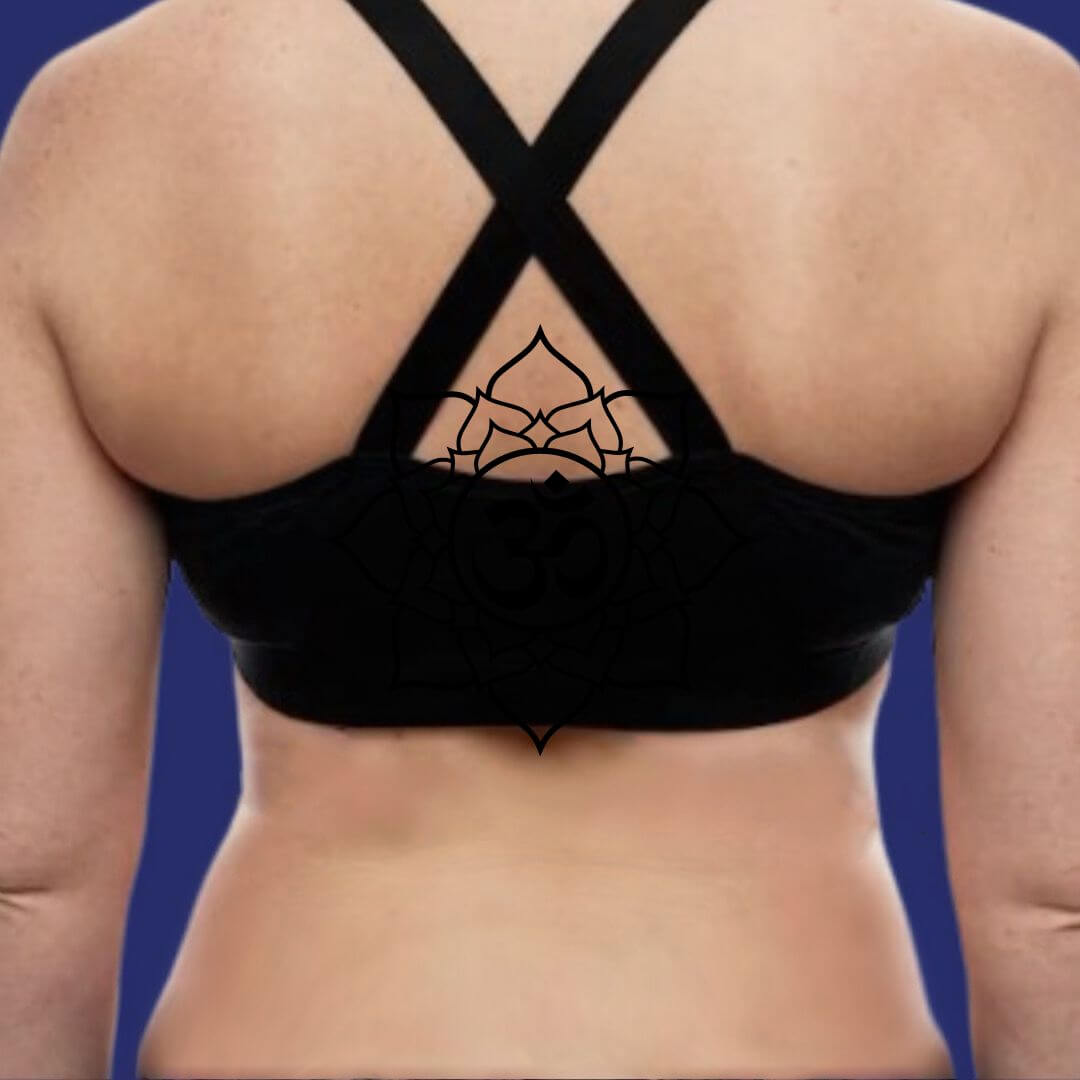 Foto na liposuctie op de rug