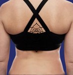 Foto na liposuctie op de rug