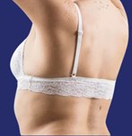 Liposuctie voor en na foto van de rug