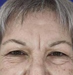 Voor ooglidcorrectie chirurgie