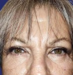 Na ooglidcorrectie chirurgie