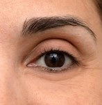 Afbeelding voor blepharoplastiek
