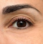 Afbeelding na blepharoplastiek