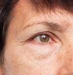 Vergelijking voor en na ooglidcorrectie chirurgie