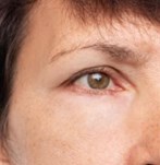 Resultaten van ooglidcorrectie chirurgie