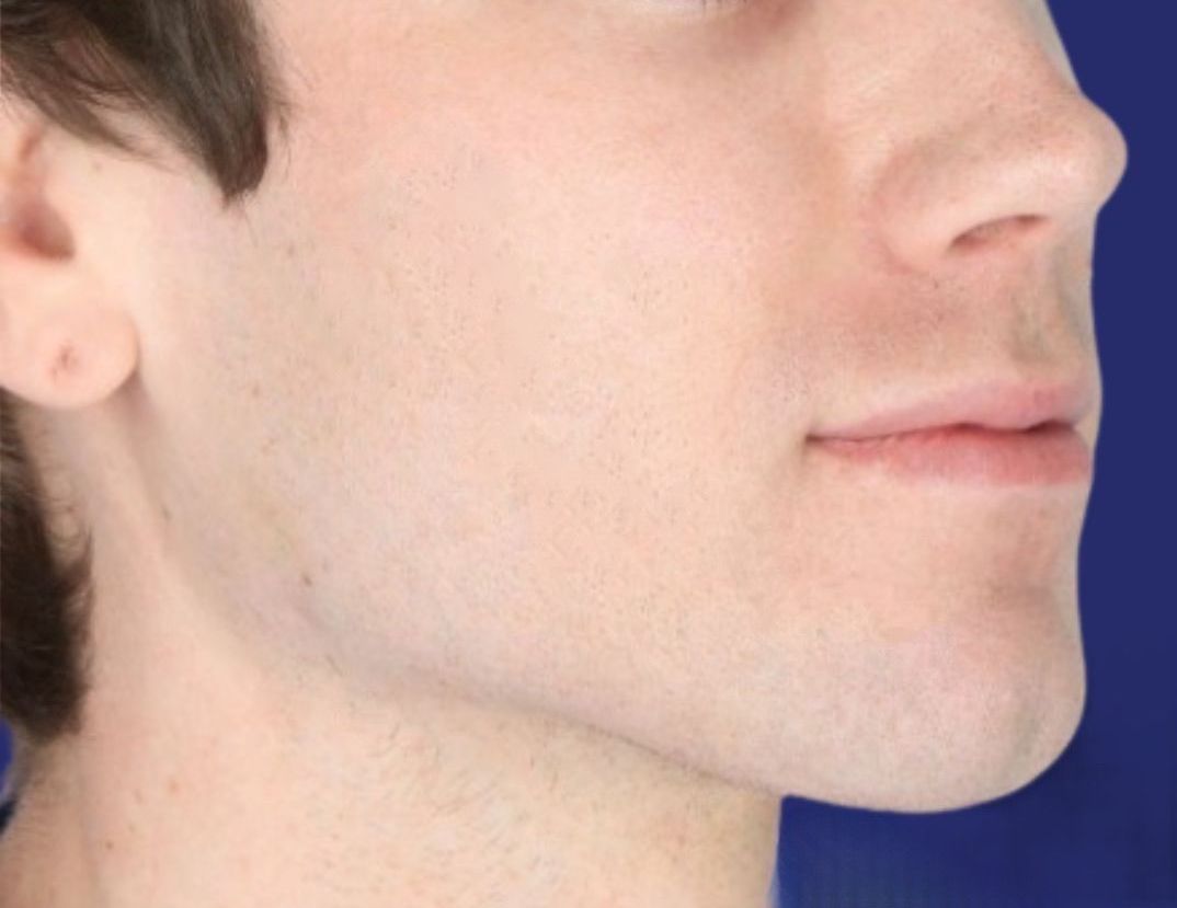 Gezichtsmaskulinisatie voor en na met fillers in kin en kaaklijn