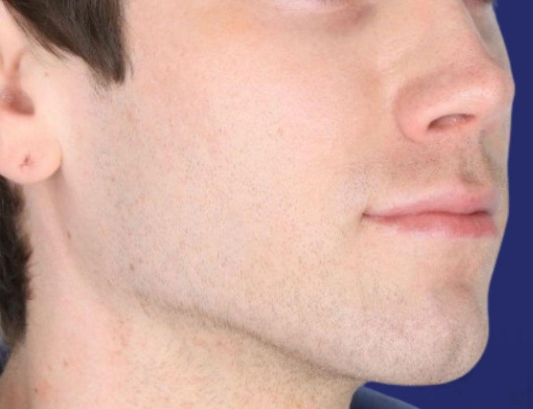 Voor-en-na-resultaten van gezichtsfillers met hyaluronzuur in België